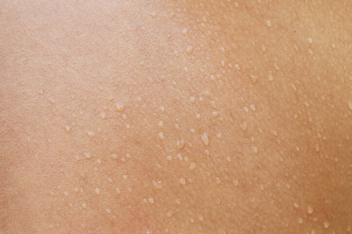 Wet skin due to inflammation, dermatitis or eczema? Know the causes