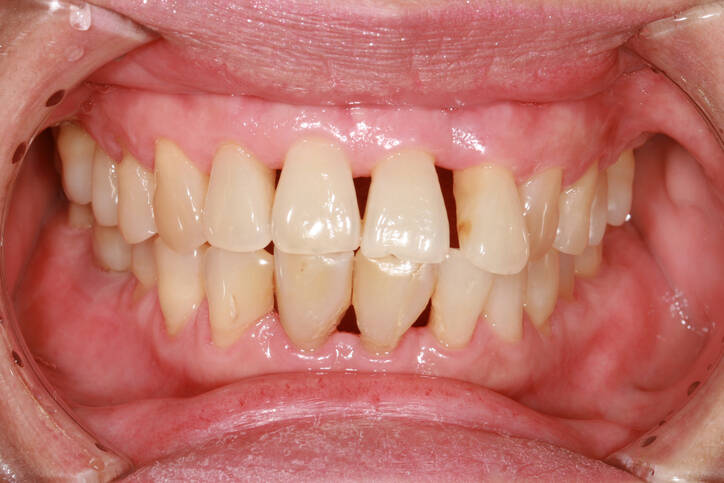 Bleeding gums: do you know the most common causes?