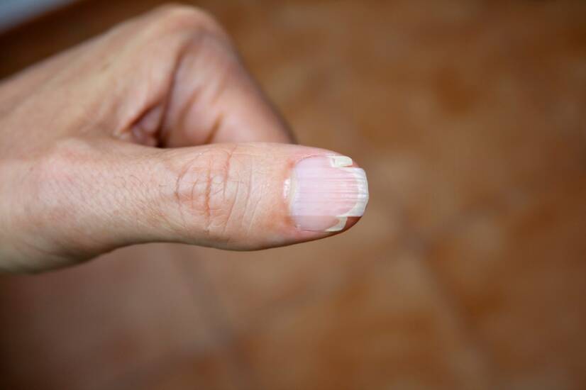 Brittle nails and their main causes? How can they be combated?