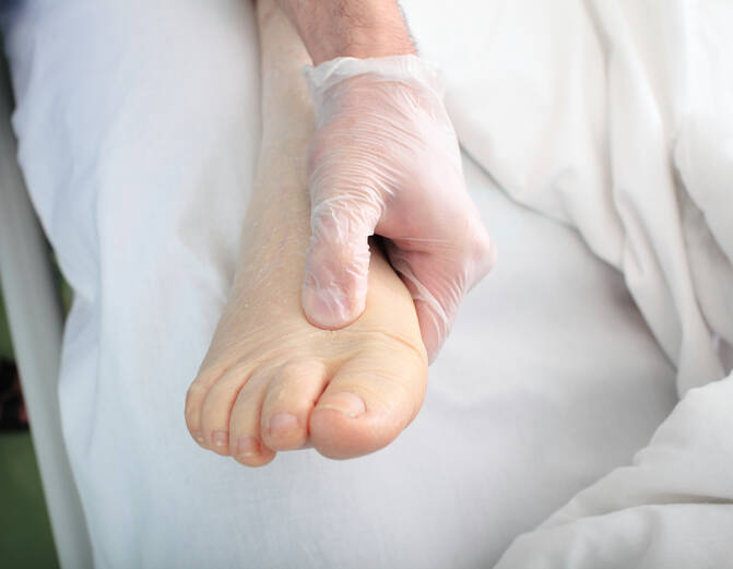 Swelling (edema) of the limbs: what causes swelling of the hands, feet, ankles?