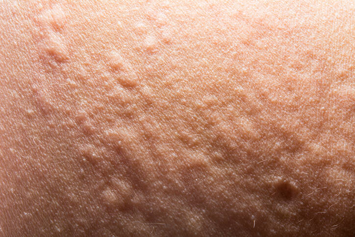 Pimples: rashes like pimples or hives and the reason for their appearance?