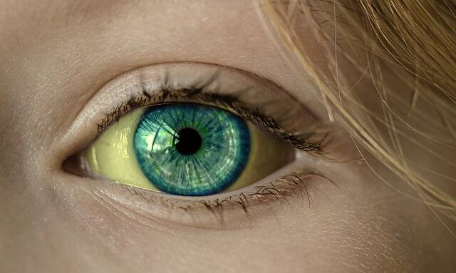 What can cause yellow whites of the eyes?