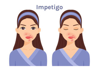 What is impetigo, what symptoms does it have? Infectivity and transmission in children