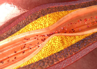 Atherosclerosis: Do you know the symptoms or causes, risks, prevention?