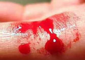 Hemophilia: What is it and how does it manifest? Do you know the causes of royal disease?