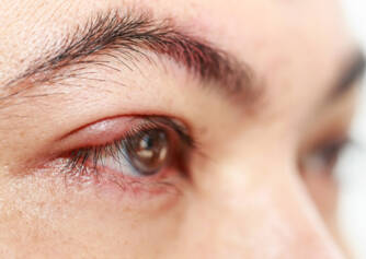 Hordeolum or barley on the eye. Why is it created, how is it treated?  (Hordeolum + chalazion)