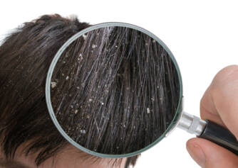 Dandruff: Why does it appear, how to get rid of it? (will granny's advice and home treatment help?)