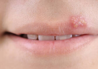 Herpes: Why does herpes develop and how is it treated?