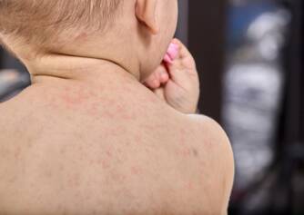 Scarlet Fever: Causes, Symptoms