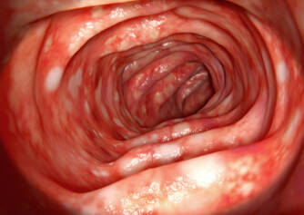 Ulcerative Colitis: Causes, Symptoms, Diagnostics