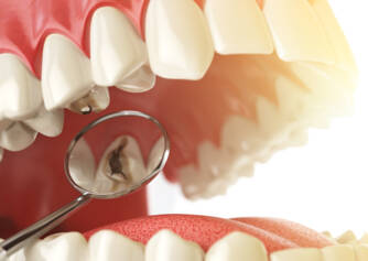 Tooth Decay: Causes and Manifestations 