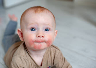 Atopic eczema - is your child suffering from it too?