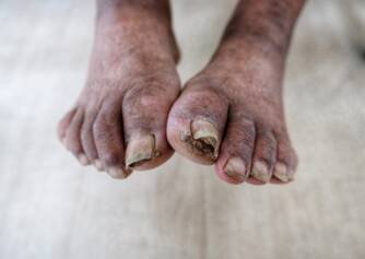 What is gangrene? What are its symptoms and treatment?
