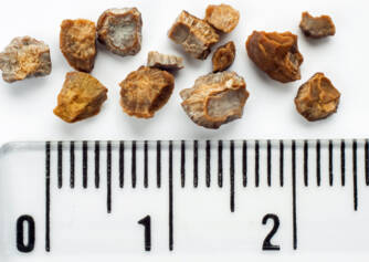 How to treat kidney stones? With herbs? How are they formed and how do they manifest themselves?