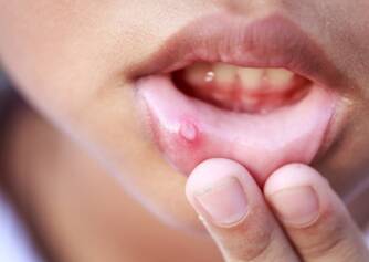 Aphthae: Causes, Manifestations, Treatment