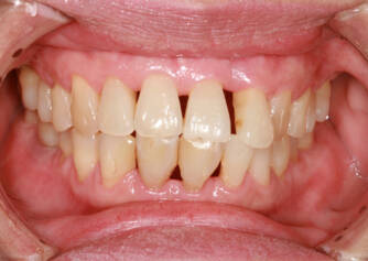 Bleeding gums: do you know the most common causes?