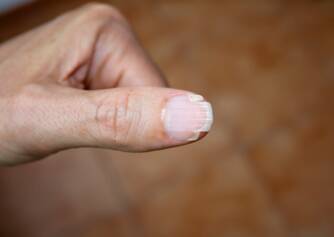 Brittle nails and their main causes? How can they be combated?