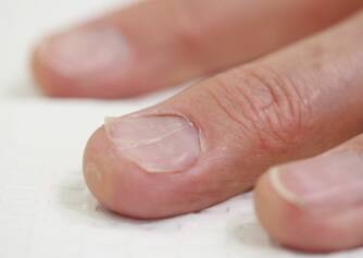 Ingrown nails: why do they arise? Diagnosis and treatment