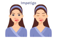 What is impetigo, what symptoms does it have? Infectivity and transmission in children