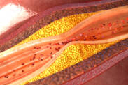 Atherosclerosis: Do you know the symptoms or causes, risks, prevention?