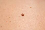 What is a fibroma on the skin, what does it look like, what symptoms does it have?