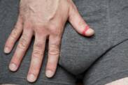 Phimosis and paraphimosis (narrowing of the foreskin): what are its causes and symptoms?