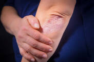 Psoriasis: Non-infectious, but long-term disease, what are its symptoms?
