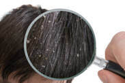 Dandruff: Why does it appear, how to get rid of it? (will granny's advice and home treatment help?)