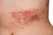 Shingles: Herpes Zoster Transmission, Symptoms, Treatment and Complications