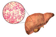 Fatty liver disease: Definition, Causes, Manifestations, Treatment