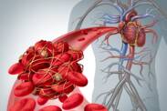 Thromboembolic disease: origin and how it relates to pulmonary embolism