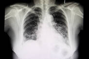 How does pneumonia manifest itself and what treatment is most effective?