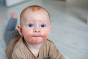 Atopic eczema - is your child suffering from it too?