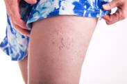 Varicose veins? This aesthetic problem is particularly troubling for women. Why?