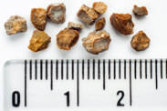 How to treat kidney stones? With herbs? How are they formed and how do they manifest themselves?