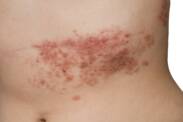Why does shingles occur? What is its most effective treatment?