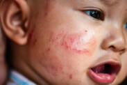 Are the symptoms of scabies in children the same as in adults? How is it treated?