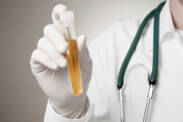 Proteinuria - Excess Protein in the Urine