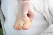 Swelling (edema) of the limbs: what causes swelling of the hands, feet, ankles?