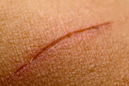 Slow wound healing: what are its causes (+ risk factors)