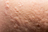 Pimples: rashes like pimples or hives and the reason for their appearance?