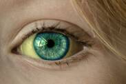 What can cause yellow whites of the eyes?