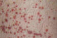 Petechiae: What are they, why do they arise, how to recognize them? In children, beware!