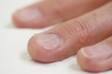 Ingrown nails: why do they arise? Diagnosis and treatment