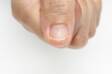 Unaesthetic nail lines: why do they occur? Can they be prevented?